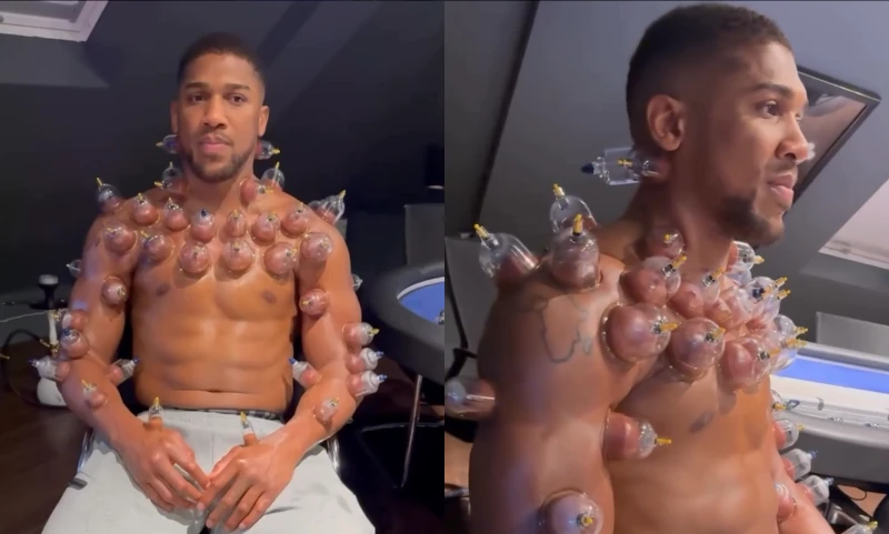 El boxeador ingles Anthony Joshua en terapia de ventosas